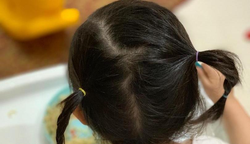 ریختن موی سر یا ریزش مو در کودکان