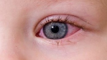 التهاب ملتحمه؛ کنژنکتیویت یا چشم صورتی در کودکان
