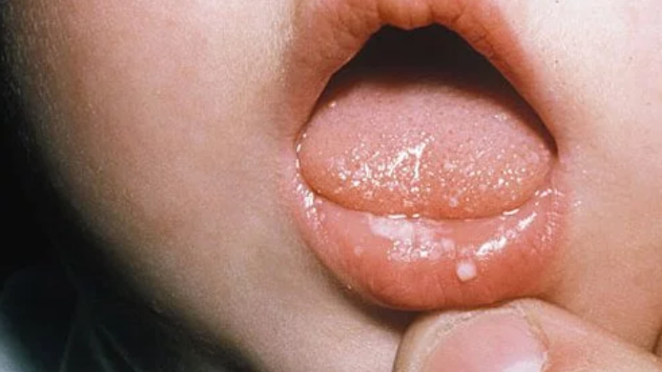 آفت دهان در کودکان