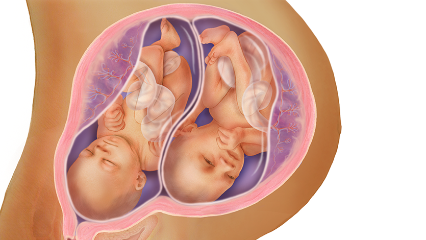 رشد جنین دوقلو در ۳۲ هفتگی