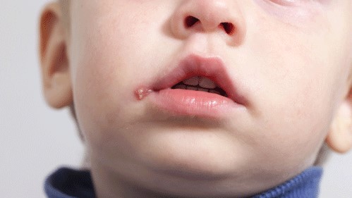 تبخال دهان در کودکان